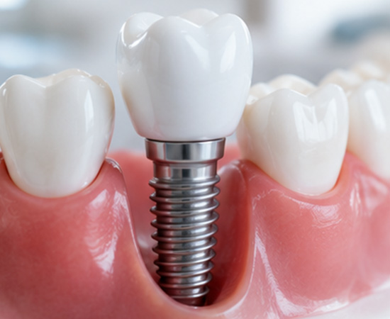 Dental Implant